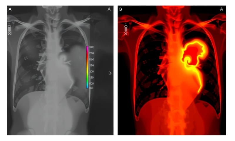 X線写真（左）と、AIが「注目した」箇所を示したヒートマップ（右）